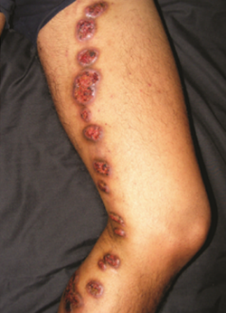 esporotricose4